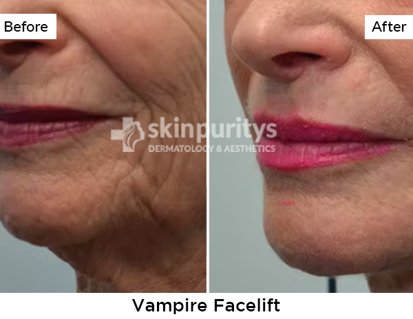 Vampire Facelift results